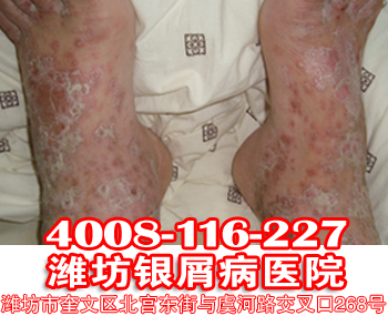 牛皮癣