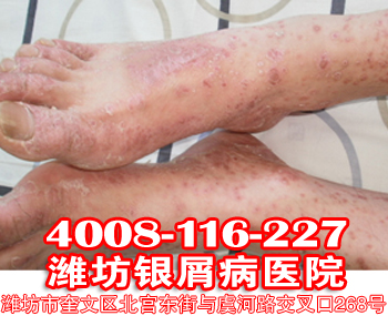 牛皮癣