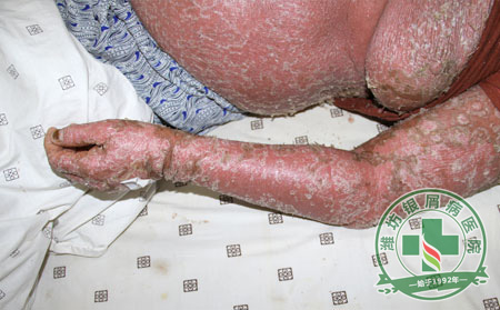 银屑病临床表现症状