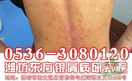 治疗牛皮癣，能够确保治治疗效果果可以吗?