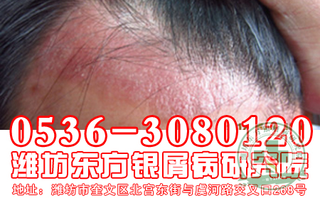 面部患有牛皮癣是怎么回事?