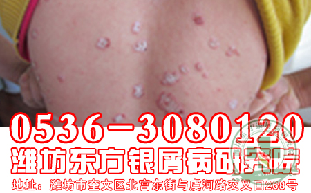 牛皮癣药物治疗的治疗误区有哪些?