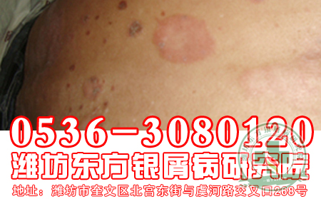患者使用西医治疗银屑病可能会产生什么危害性后果？【山东医院】
