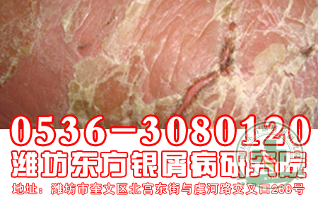 银屑病发病会给患者的社会生活和日常生活造成哪些影响？【新闻专