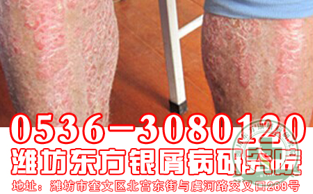 寻常型牛皮癣消退期症状如何