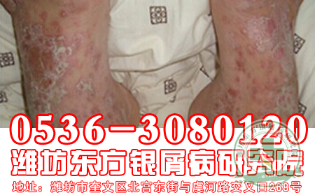 哪些食物是牛皮癣患者不应该触碰的
