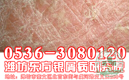 牛皮癣饮食需要遵循的“三大原则