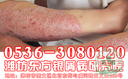 医生回答患者：牛皮癣是不是一种传染病