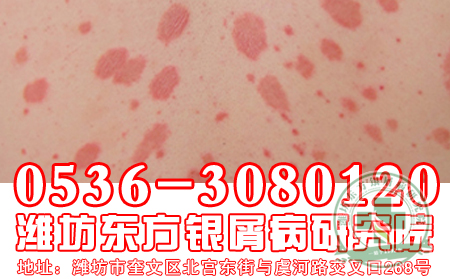 治疗牛皮癣应该做到哪些？【医生介绍】