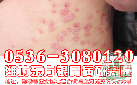 银屑病患者喝什么茶能祛除口臭？