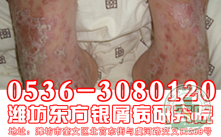 银屑病久治不愈的病因有哪些？【医院在线】