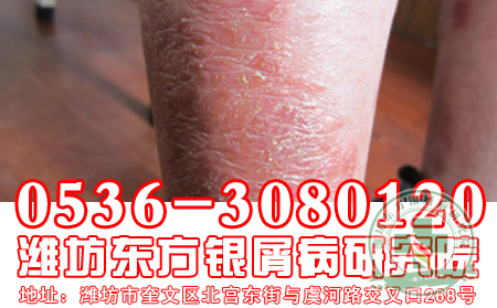 银屑病患者的药物使用要注意的问题有什么？