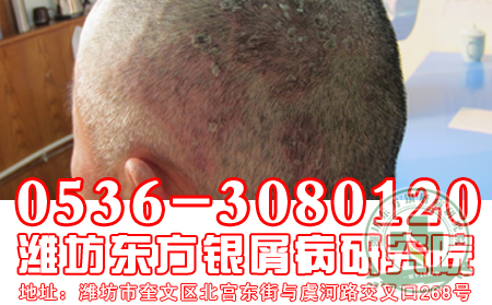 银屑病的发病症状是什么样的？