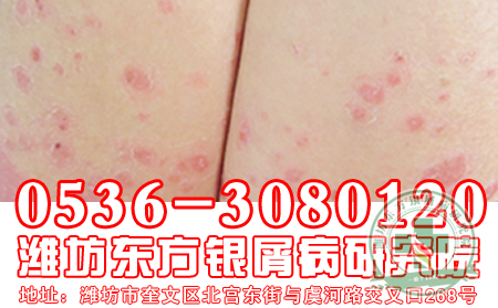 双氧水可以治疗银屑病吗？