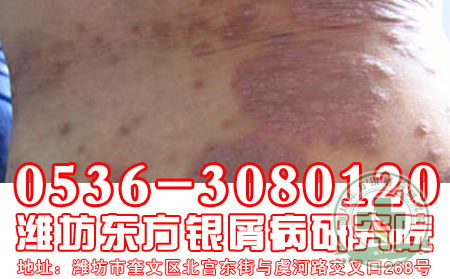 牛皮癣患者怎样应对皮肤瘙痒