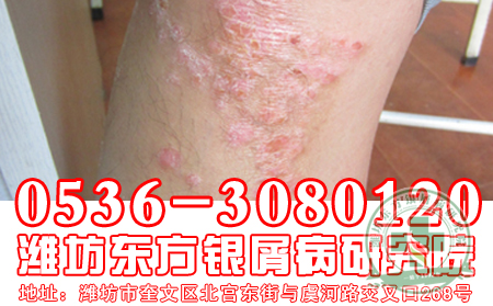银屑病患者应该怎样进行治疗？