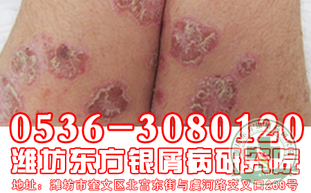 关节型银屑病诊断方法有哪些？