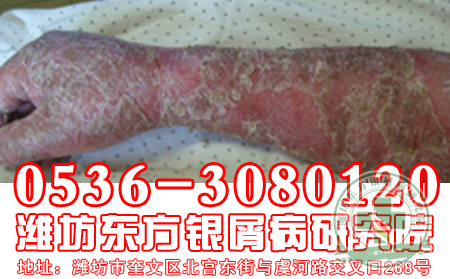 失恋也会导致银屑病发病吗？【临床医院】