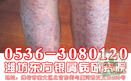 银屑病患者的饮食工作该怎样做？