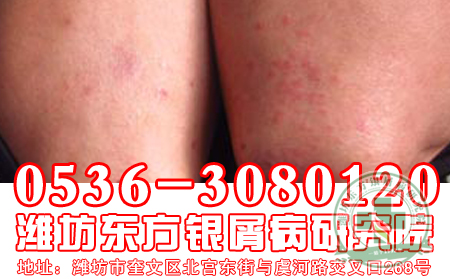 牛皮癣患者日常护理适合用香皂吗