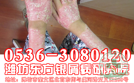 银屑病发病真的与传染有什么关系吗？