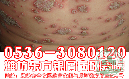 牛皮癣怎么治疗较可以？
