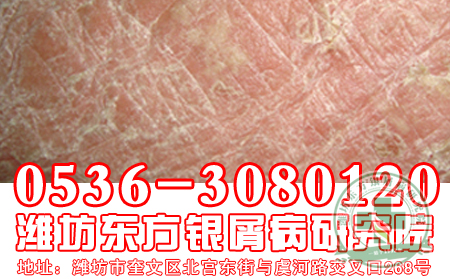 银屑病发病后的常见伴发疾病有什么？【牛皮癣口碑】