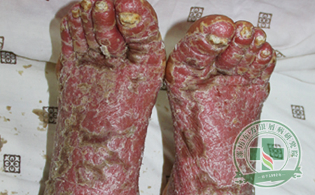 济南银屑病医院—牛皮癣误区常识