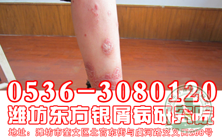 红皮型银屑病你知道些什么？