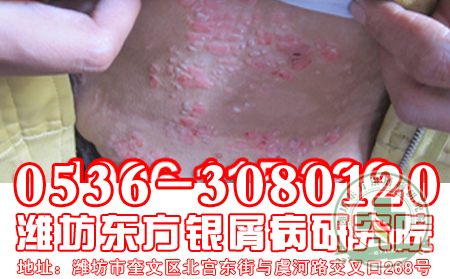 惊！身上突然起了红疙瘩，是银屑病吗？