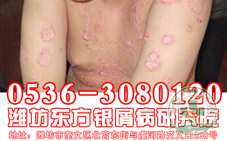 捷报！防止银屑病复发，我们有一套