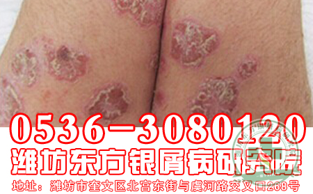 银屑病患者保健无从下手？comehere医生给你支招