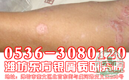 盘点牛皮癣其他方使用三大危害