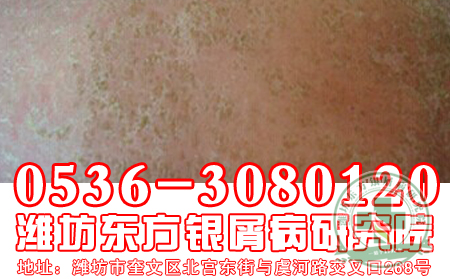 牛皮癣发病后患者千万不要吃的食物有哪些