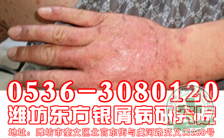 性格有问题，银屑病找上你