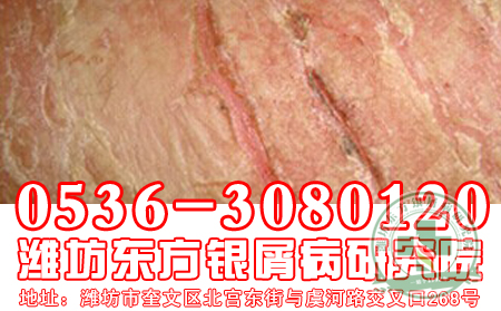 脓疱型牛皮癣治疗要注意什么