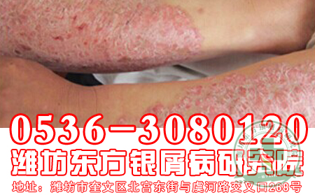 牛皮癣患者生活中宜吃食物有哪些