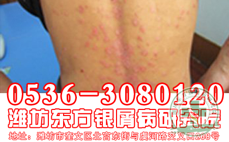 不容忽视的牛皮癣病因?