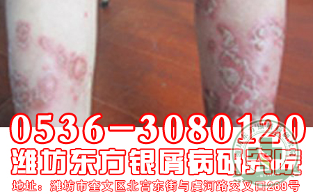 预防牛皮癣,济南牛皮癣医院医生办法多