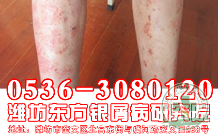 牛皮癣患者有哪些错误心理?