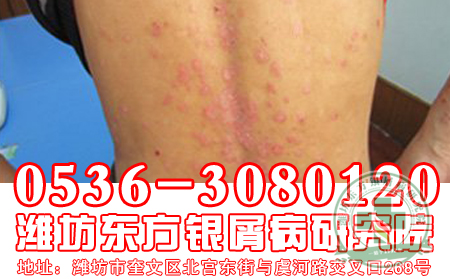 医生建议牛皮癣患者夏季多吃西红柿