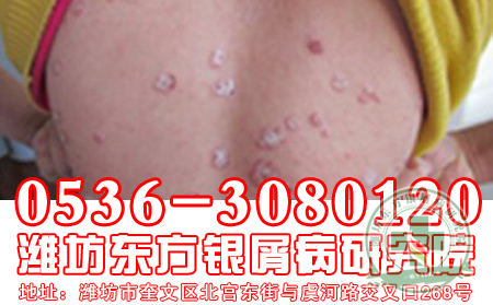 同年龄段诱发牛皮癣的主要因素是什么?
