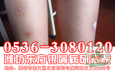 牛皮癣患者提问：牛皮癣发病初期有什么临床表现?