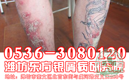 夏季牛皮癣患者要注意