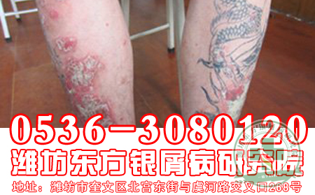 消退期牛皮癣症状的表现
