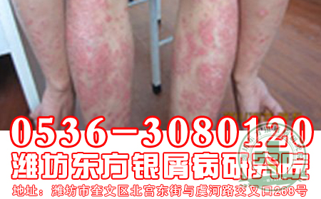 牛皮癣夏季预防攻略