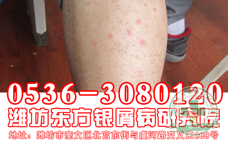 牛皮癣患者吃什么水果可以？
