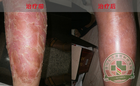 山东牛皮癣医院—银屑病患者怎样恢复的更快