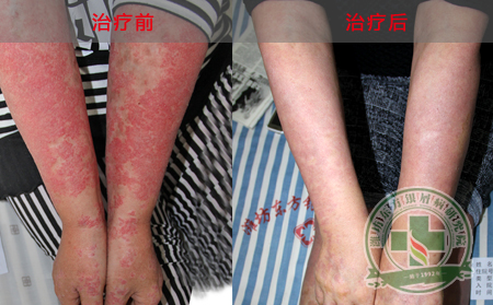 济南牛皮癣医院详述红皮型银屑病