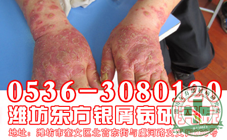 济南银屑病医院—银屑病治疗误区解读